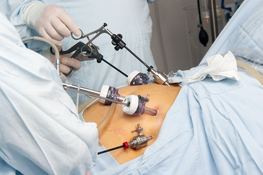 Laparoscopic Varicocelectomy