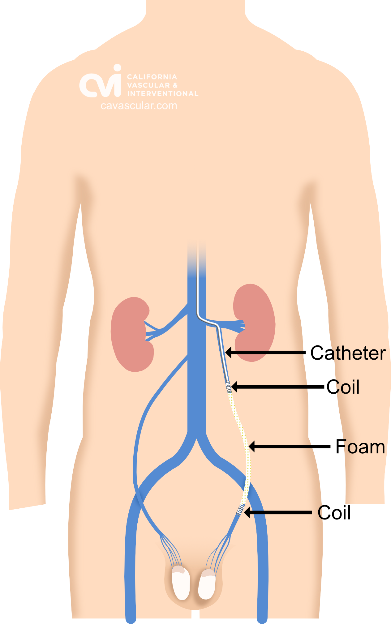 Non Surgical Embolization California Varicocele Doctor